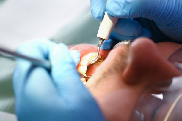 Best Emergency Dentist for Knocked-Out Tooth in Wray, CO